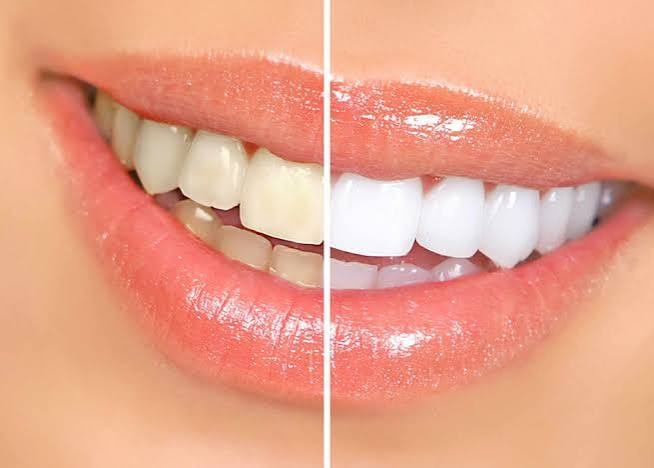 Clareamento Dental - Clínica Yamada Odontologia